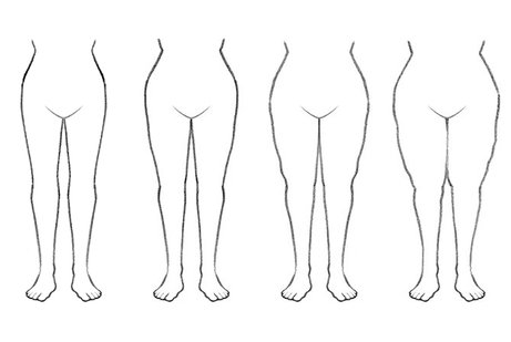 The four stages of lipoedema.  Lipo-lymphoedema is also sometimes referred to as stage IV of lipoedema.