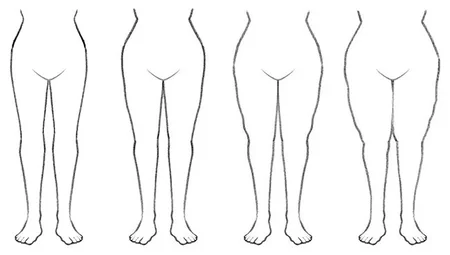 The different stages of lymphedema.