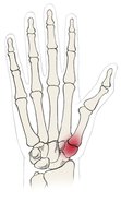 Rhizarthrosis is a degenerative disease effecting the thumb saddle joint.