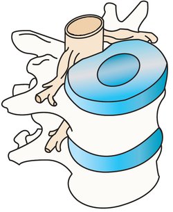 De anatomie van een tussenwervelschijf (blauw)