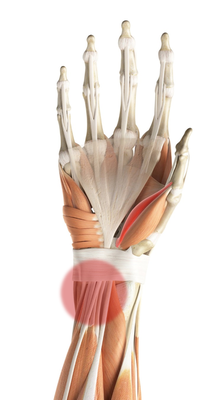 An image of an affected wrist.