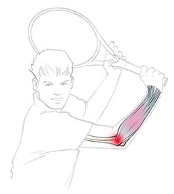 Bei einem Tennisarm schmerzt die Außenseite des Ellenbogens. Tennisarm grafisch dargestellt