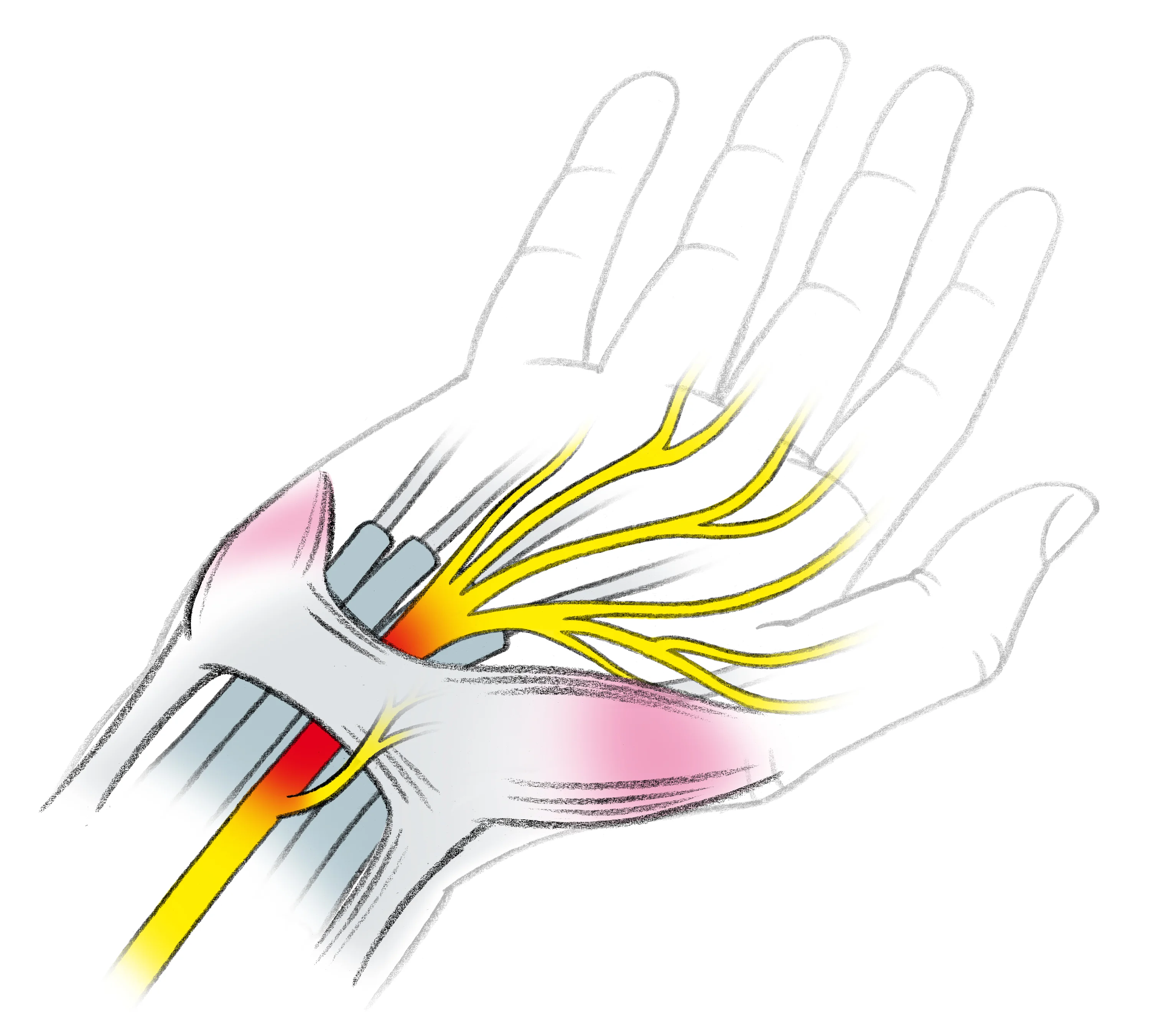 Hand Karpaltunnelsymdrom