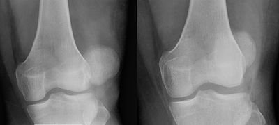 Röntgenbild Patella-Luxation | Ofa Bamberg