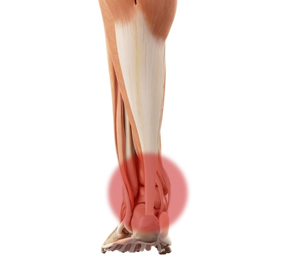 In cases of an Achilles Tendon Rupture, a lump is clearly palpable.