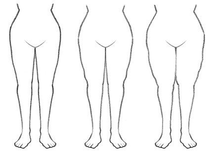 The different stages of lipedema.