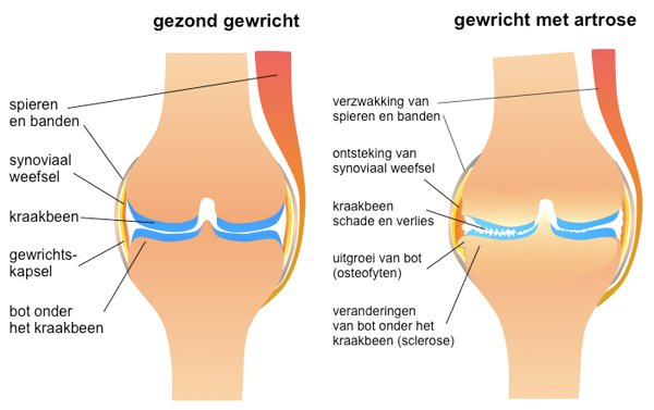 De verschillen tussen een gezond kniegewricht en een kniegewricht met artrose