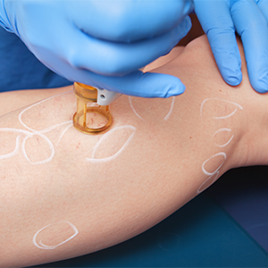 Mittels Lasertherapie können Krampfadern behandelt werden. Mittels Lasertherapie können Krampfadern behandelt werden.