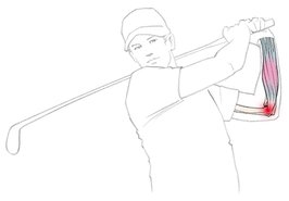 Graphic depiction of Golfer's Arm.