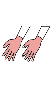 Kompressionshandschuh mit oder ohne Finger