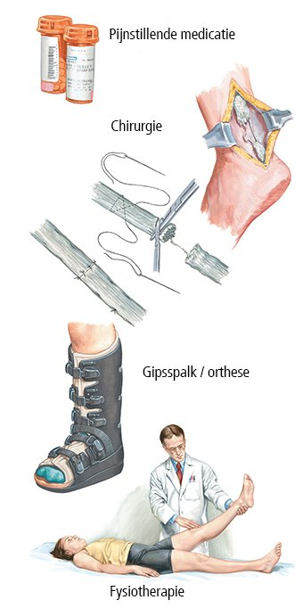 De behandeling van een Achillespeesruptuur kort samengevat.