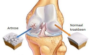 Knie artrose met uitgebreide kraakbeenbeschadigingen.