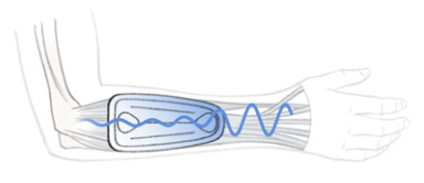 Epicondylitis supports on an affected arm.