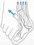 Beim Hallux Valgus verbreitert sich der Vorfuß und die Muskeln verändern ihre Zugrichtung.