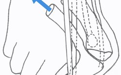 Beim Hallux Valgus verbreitert sich der Vorfuß und die Muskeln verändern ihre Zugrichtung.