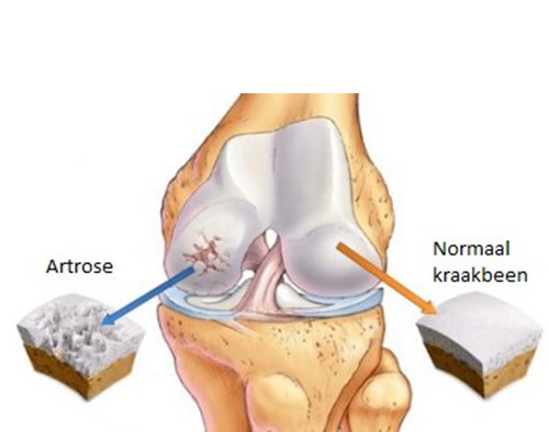 Bij artrose bestaat kraakbeenschade tezamen met botveranderingen/-schade.