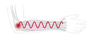 A diagram showing how movement in the muscle creates pain and inflammation.